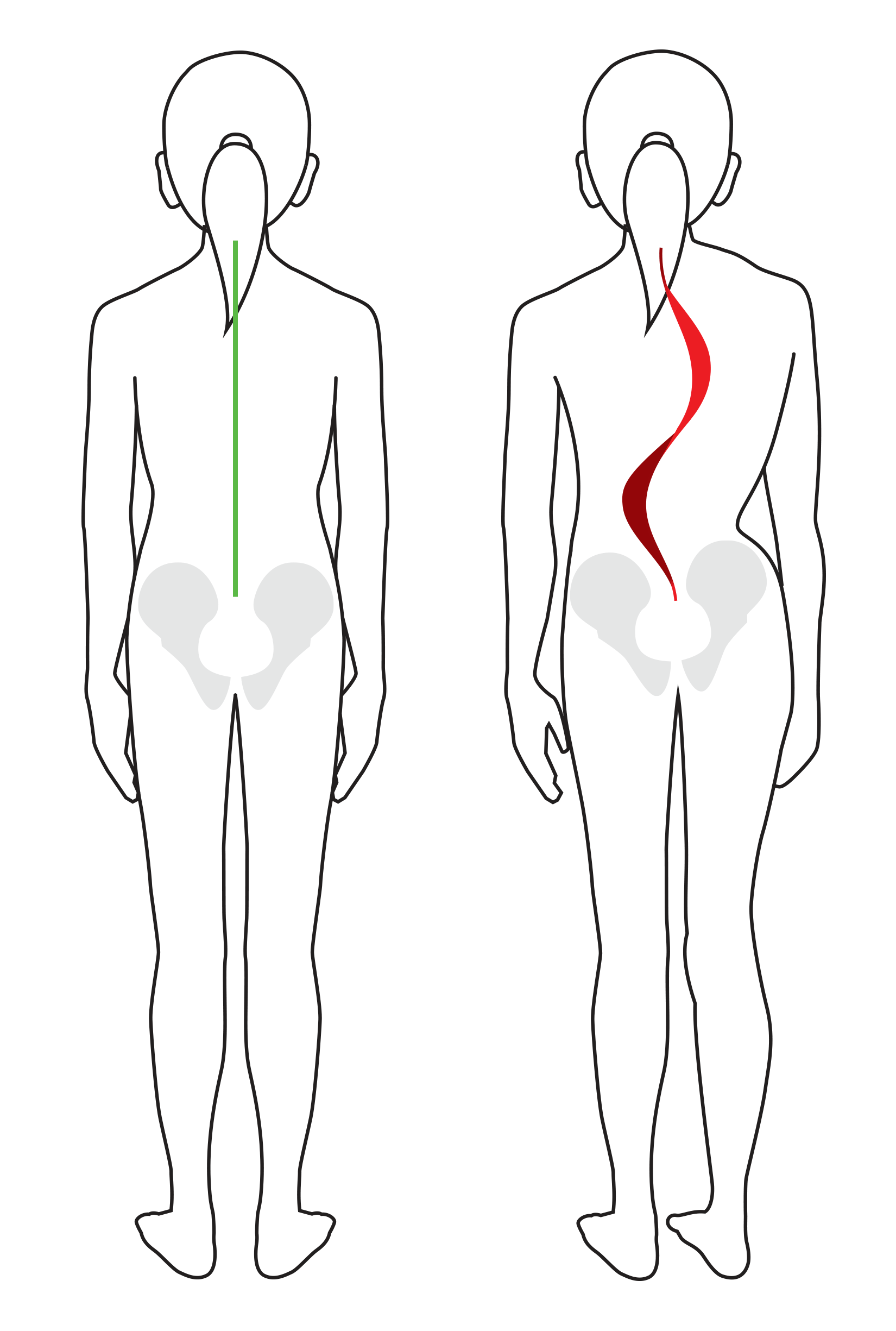 Scoliosis