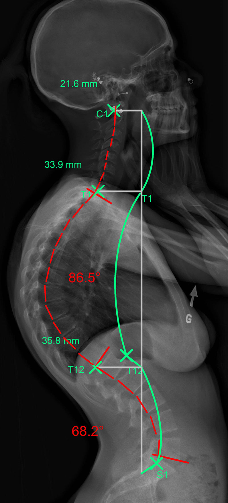 Kyphosis [image]