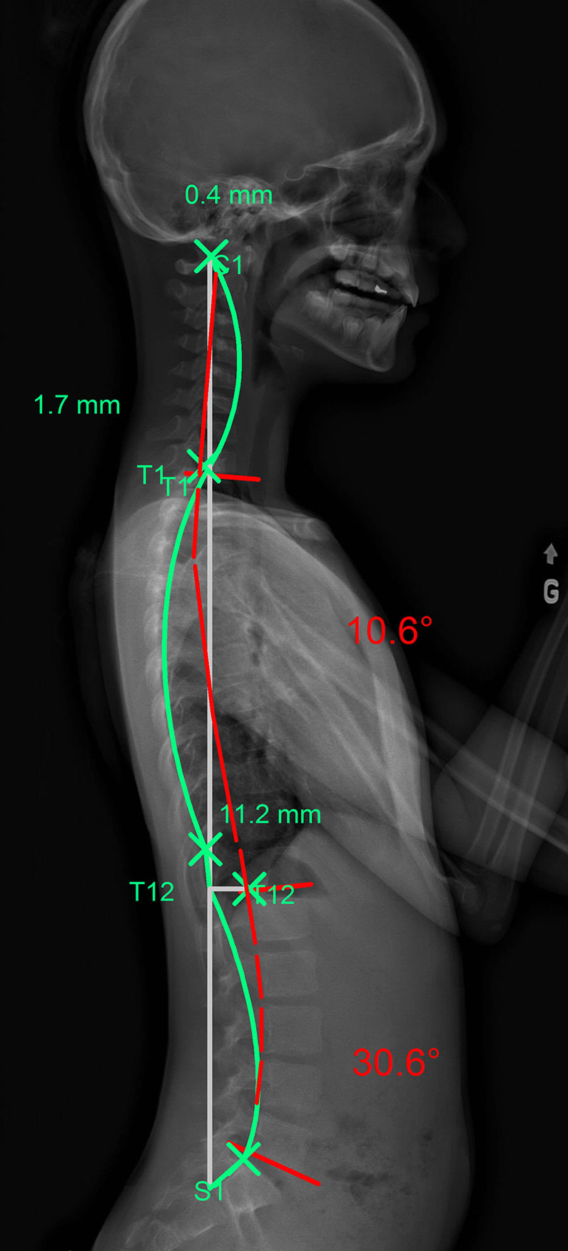 Kyphosis [image]