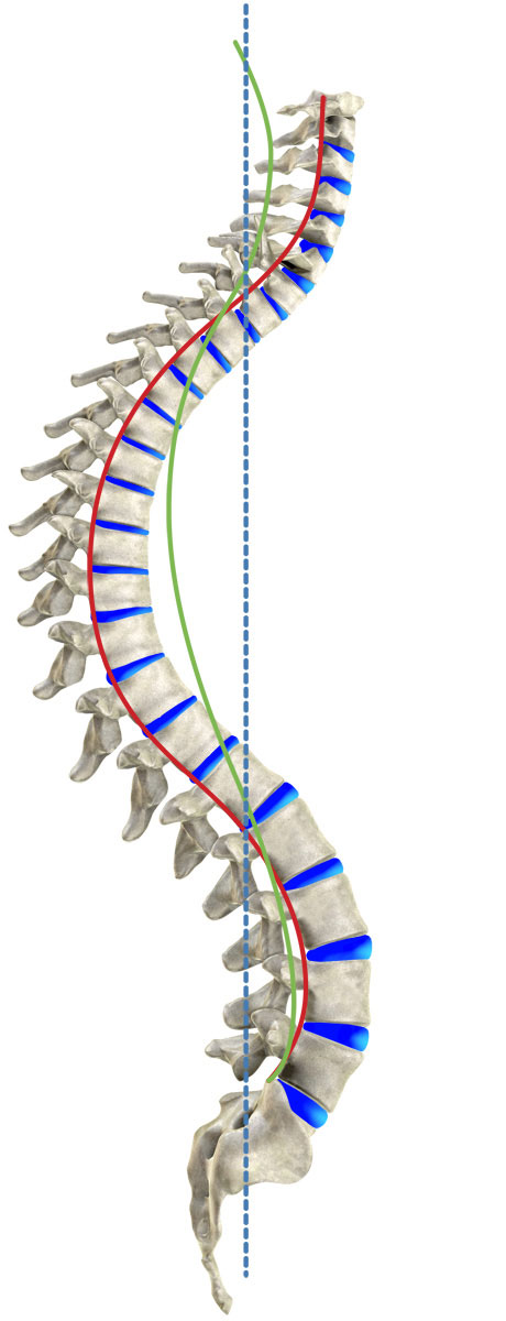 Kyphosis [image]