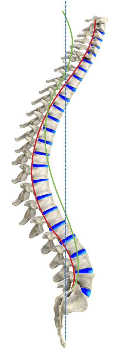 Kyphosis [image]