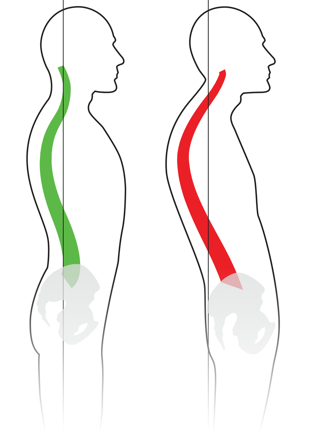 Kyphosis [image]