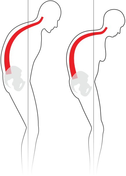 Kyphosis [image]