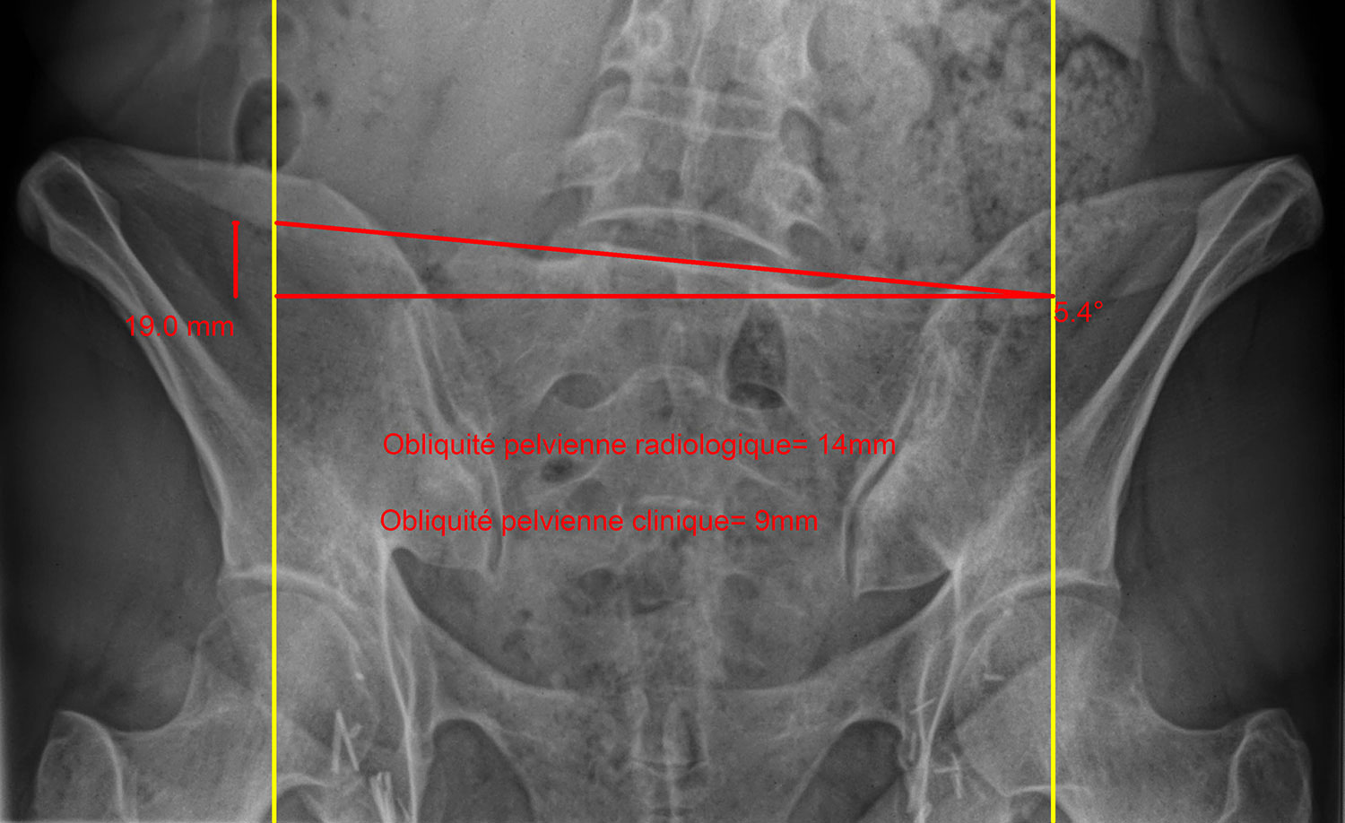 Pelvic obliquity [image]