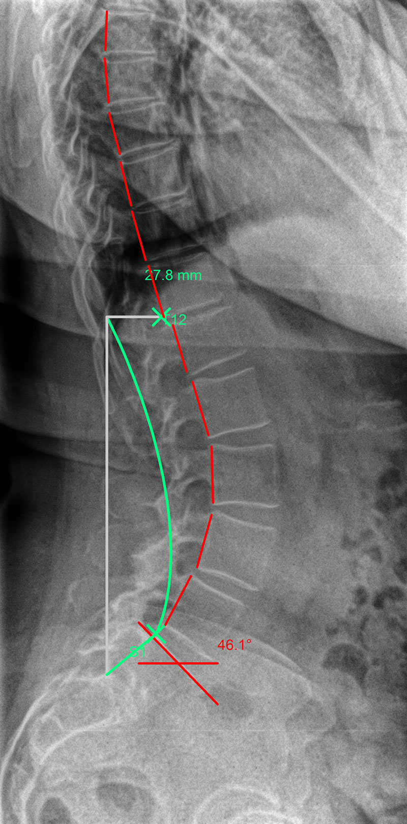 Kyphosis [image]