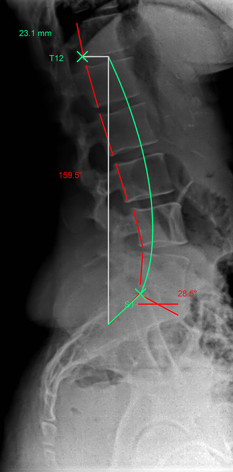 Kyphosis [image]