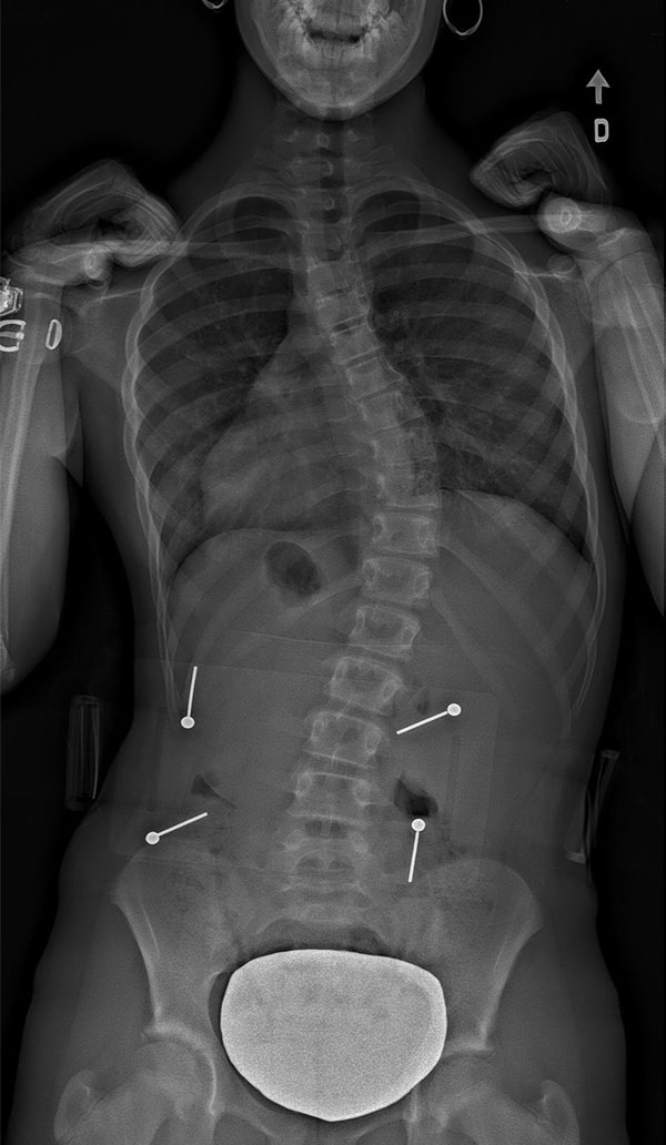 SCOLIOSIS