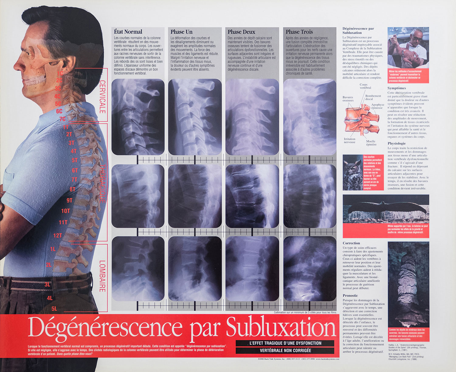 Subluxation vertébrale